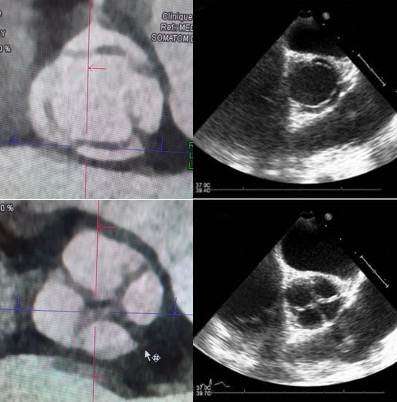 Quadricuspid aortic valve on CCTA ... a very rare cause of aortic regurgitation 🍀 #YesCCT #noechogenicityproblem @mirvatalasnag @TernacleJ @bibi0562 @arthurCESCAU @SABOURETCardio @CSmuclovisky @purviparwani @DrMarthaGulati