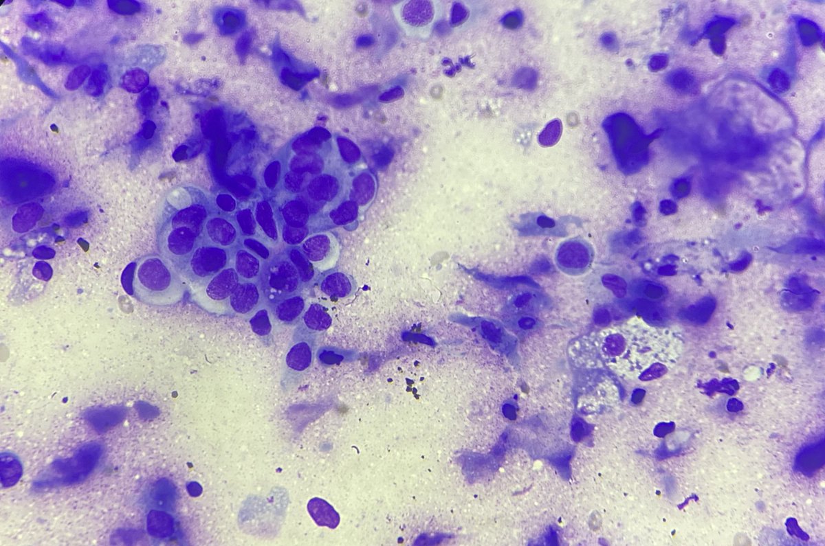 AparajitaSur2's tweet photo. Beautiful Squamous cell carcinoma in ascitic fluid . #Pathlove https://t.co/I7ygAIRQWz