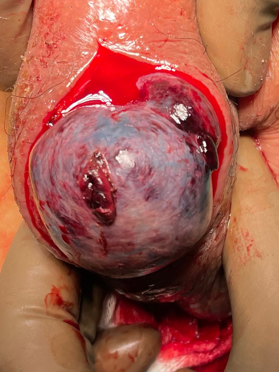 Sad that we still see neglected torsion testis in young kids who waste precious time getting treated as orchitis or getting investigated to confirm the diagnosis. 
A community program and education is needed to stress the urgency of the situation.