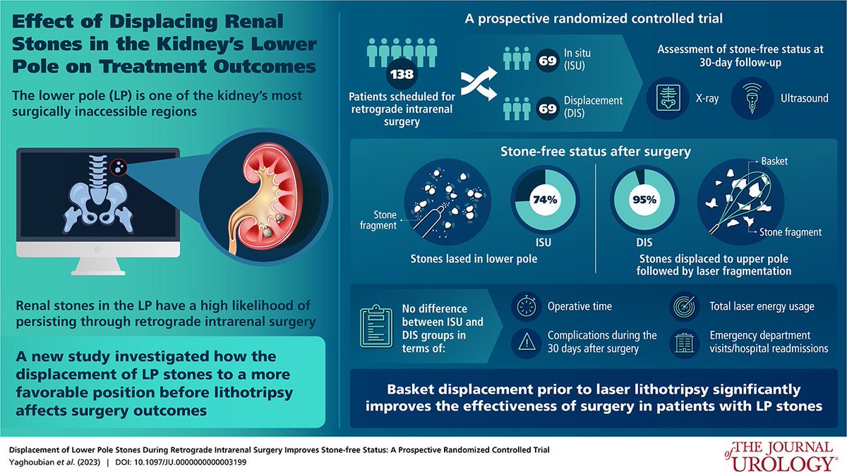 🔍In situ lithotripsy vs. Basket displacement in RIRS for LP stones

🔥 Higher SFR in displacement group (95% vs 74%), p: .003

✅Technique simple
✅Atraumatic
✅No additional costs 
✅No additional operative time
✅30-day complications, emergency visits or readmission similar