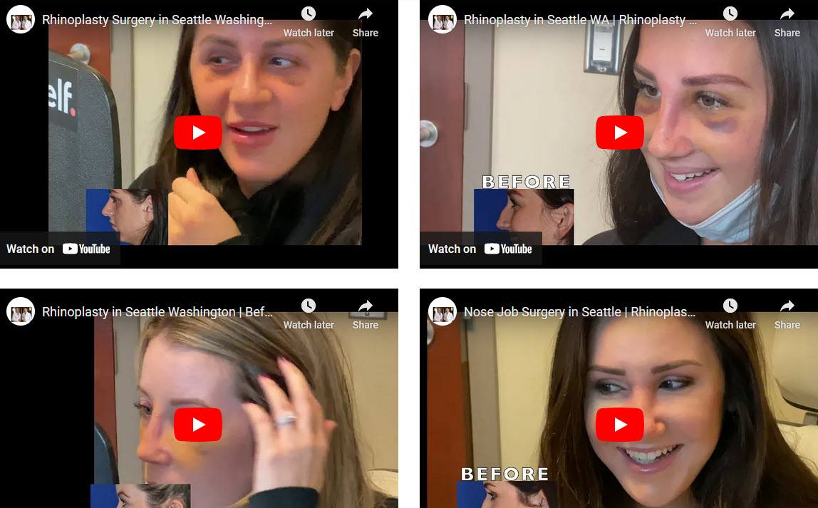 Rhinoplasty Reveal - My New Nose – Rhinoplasty Reveal - My New Nose rhinoplastyreveal.com