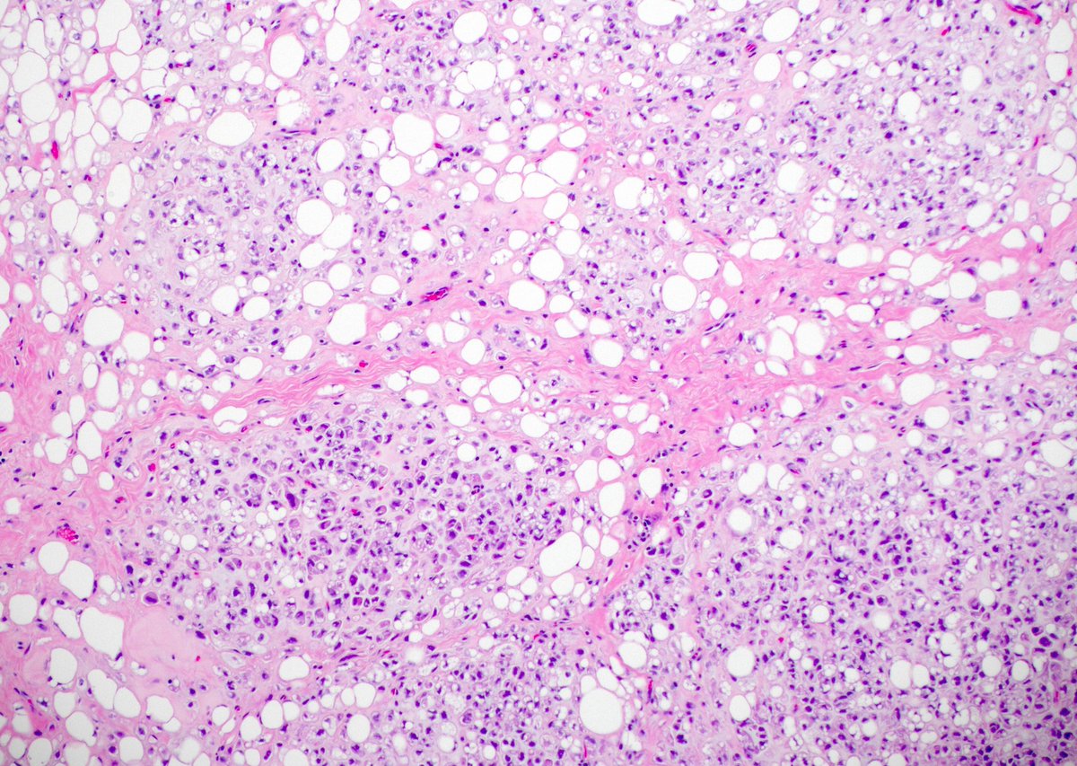 35 yo F. 4 cm leg mass. Can you make the diagnosis from one pic, or is it #TooCloseToDiagnose? (hint: all that has lipoblasts is not liposarcoma!)
Answer &amp; Video ⏯️ kikoxp.com/posts/15992 
#BSTpath #pathologists #pathology #pathTwitter