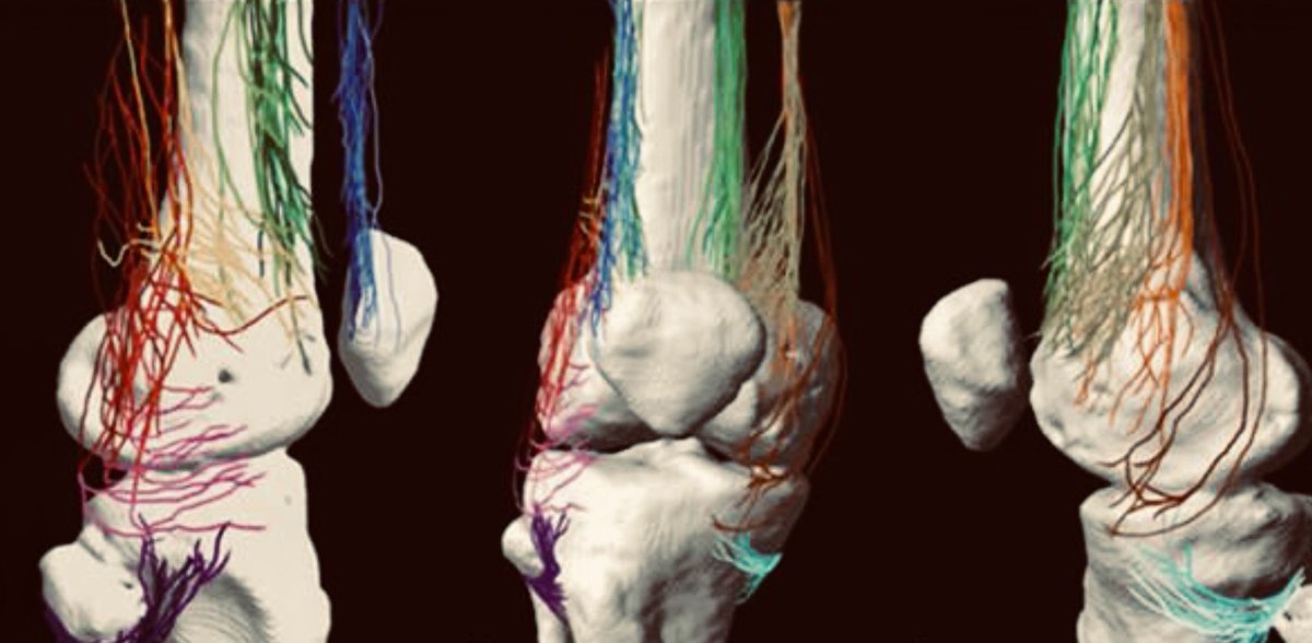 🔊 📝 #PainTreatmentSeminars 

📆 25 April 2023, 8:00am  #webex @incliva_iis

💉 💊 🦵🏼News on knee surgery 

🧑🏼‍⚕️@edupassariello M.D.

#AcutePain  #ChronicPain 

@GVAclinic
@GVAsanitat
@sedar_es
@ESAIC_org 
@SCISEDAR
@Sedolor