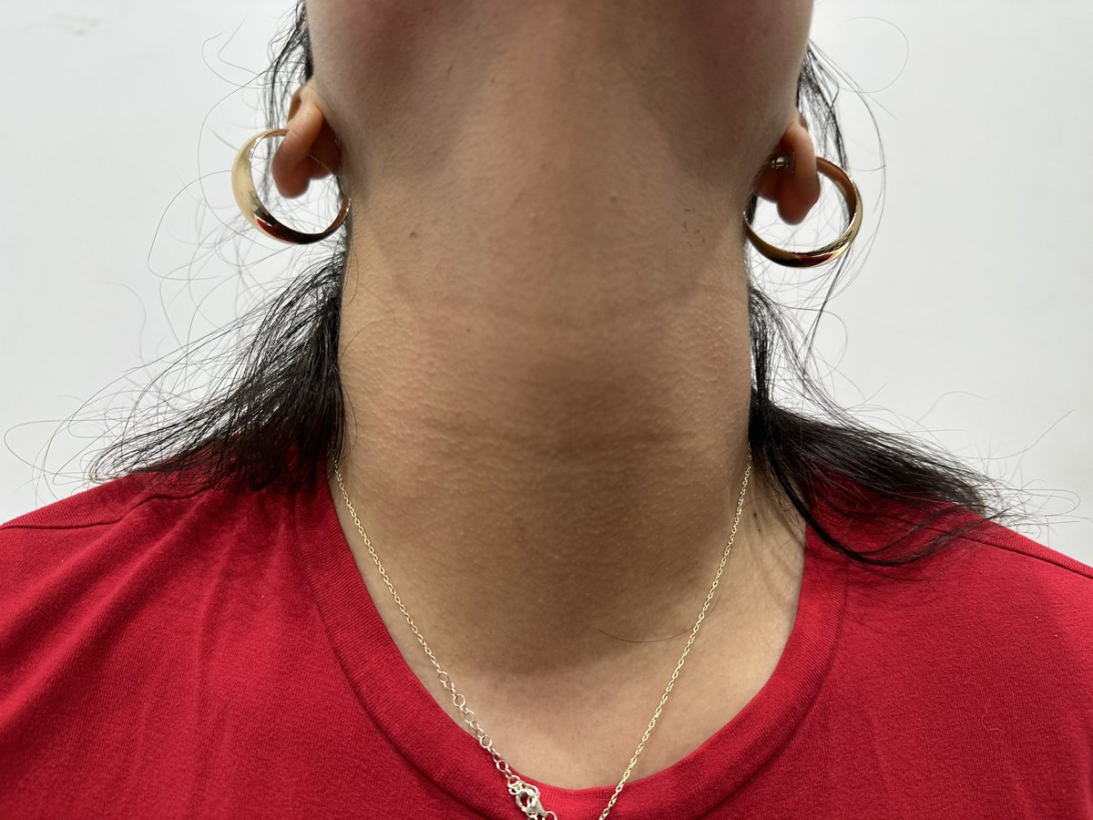 TanliciousTan's tweet image. Hands and Neck &amp;gt; Laser Hair Removal⚡️
.
This client couldn’t stand those pesky little hairs on her hands and neck, so we had to get rid of them #Zapzap
.
@tanlicioustan
#Laser #LaserHairRemoval #Hands #neck #hairfreecarefree