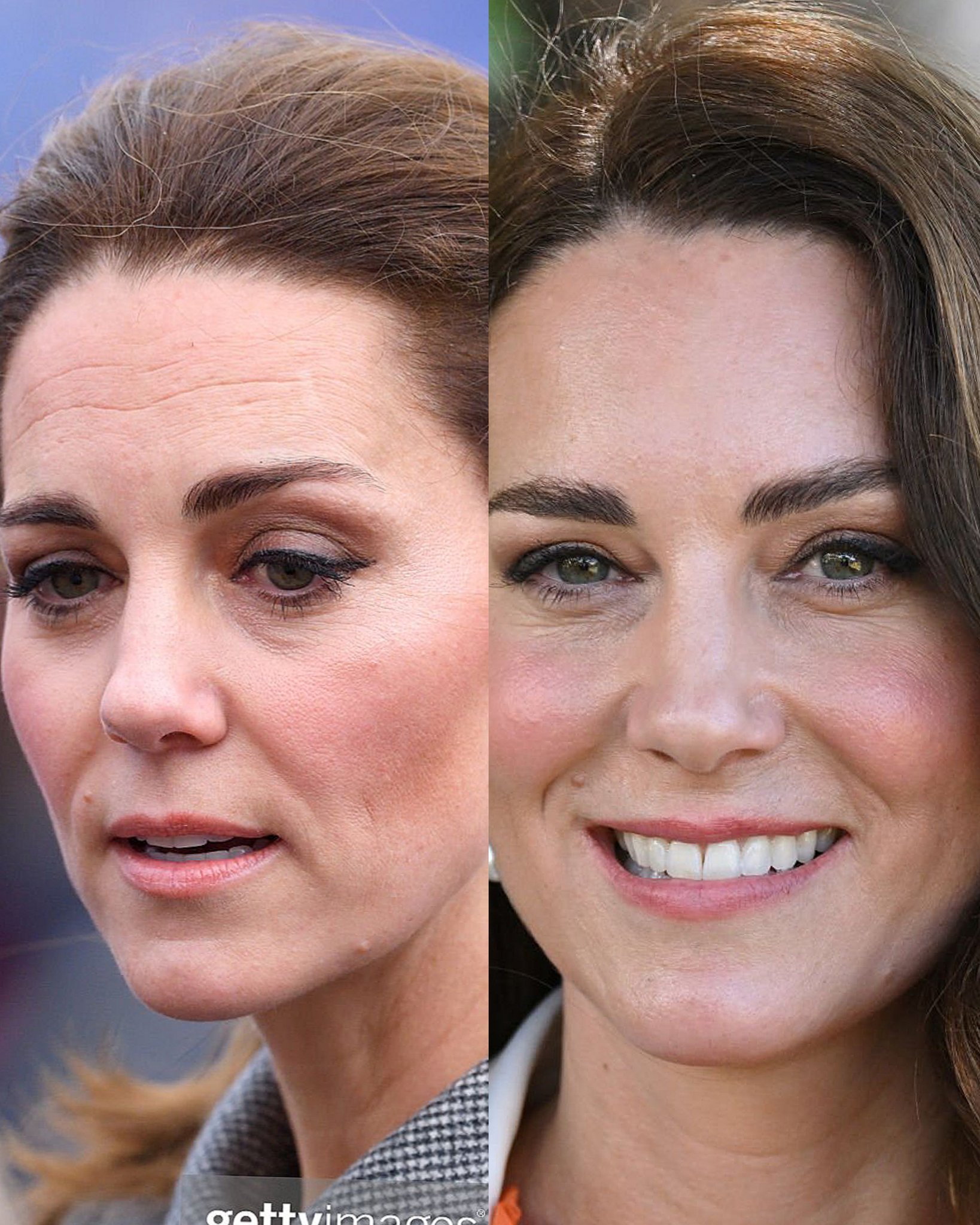 Kate Middleton Before And After