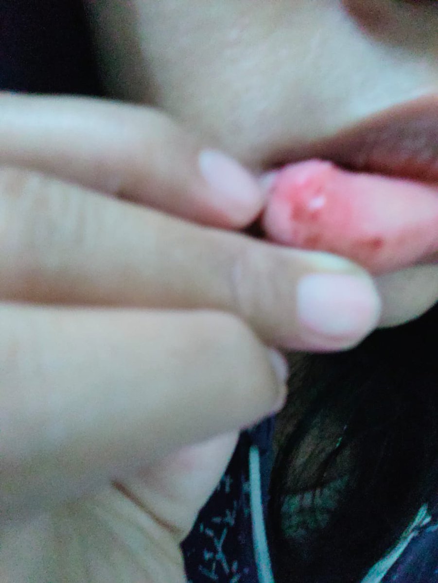 Muka Bapak saya hancur, hidung patah. Adik perempuan saya bibirnya berdarah. Si bayi alhamdulillah selamat, tidak terluka sedikitpun.