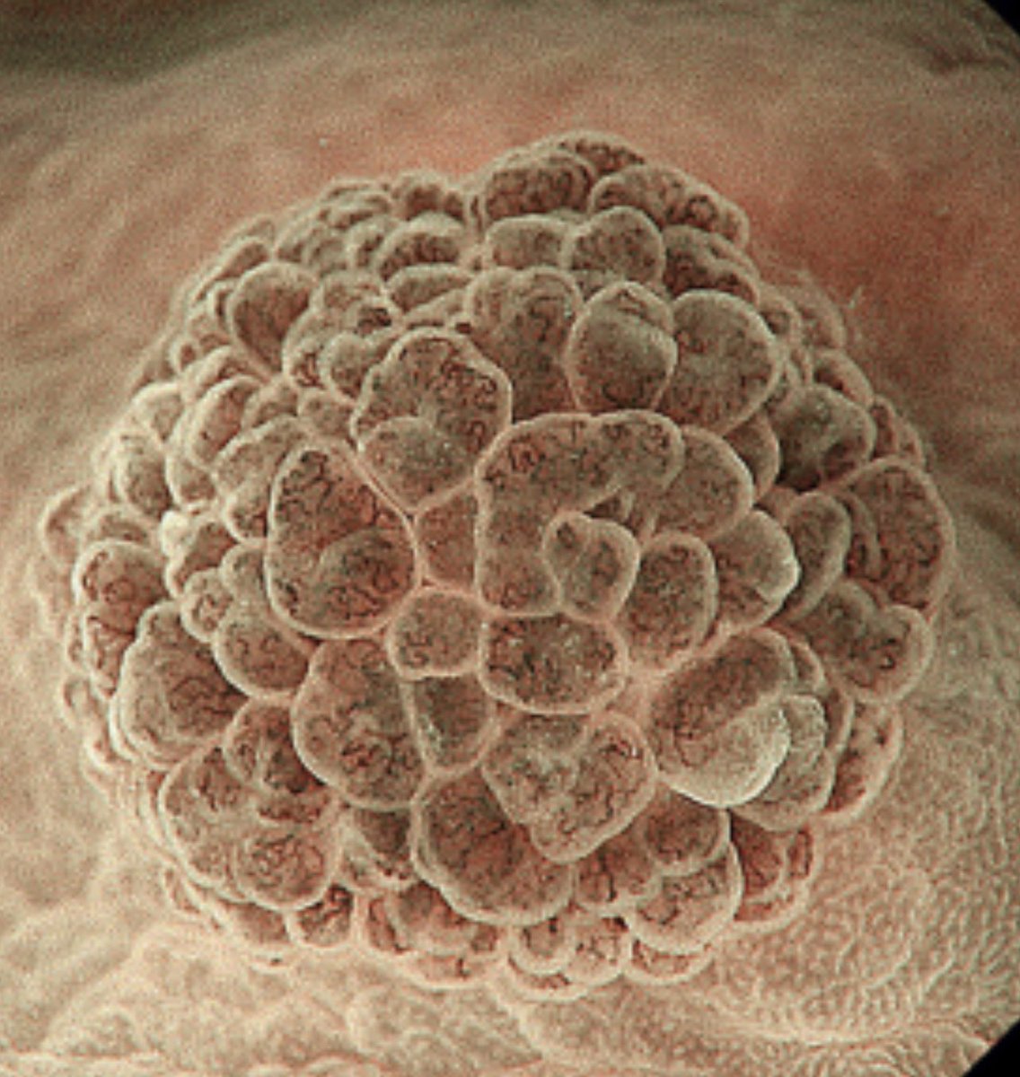 Mööp on Twitter "RT drkeithsiau Raspberry like lesion in the stomach