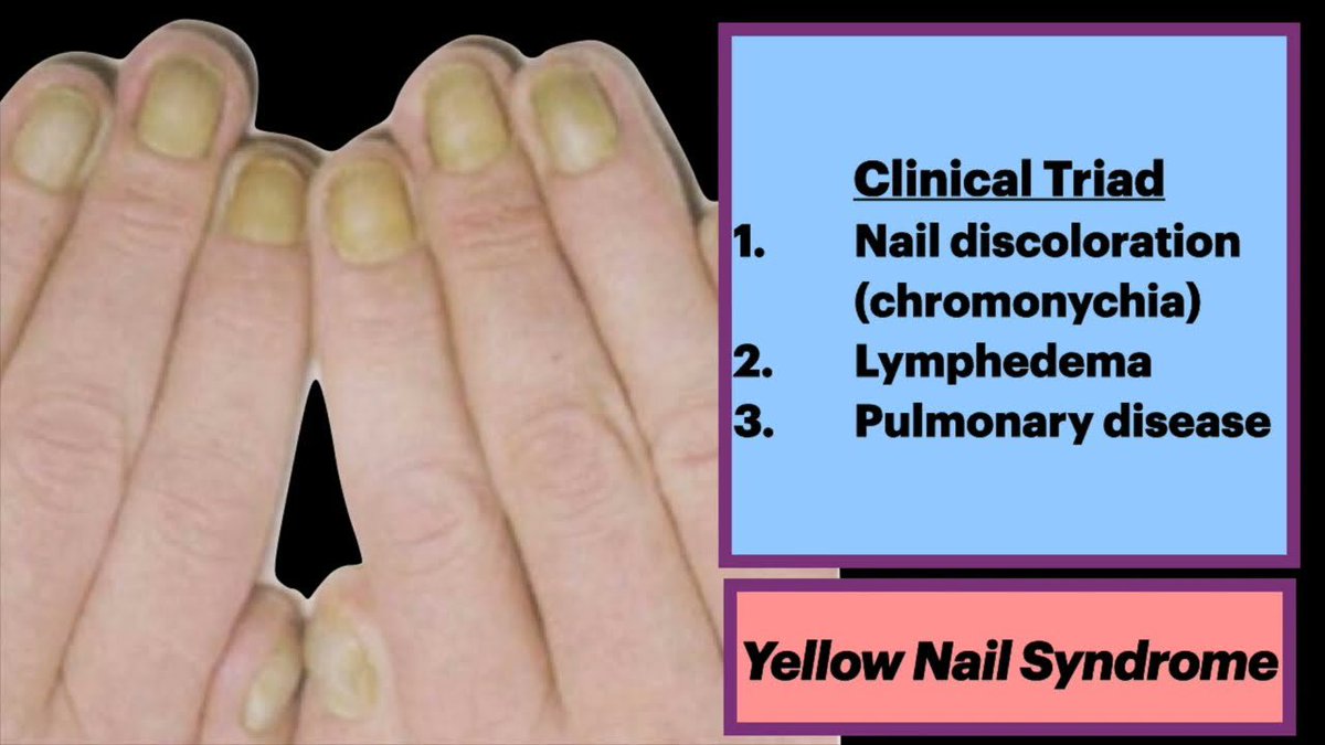 Keith Siau on Twitter "This is known as yellow nail syndrome. In a