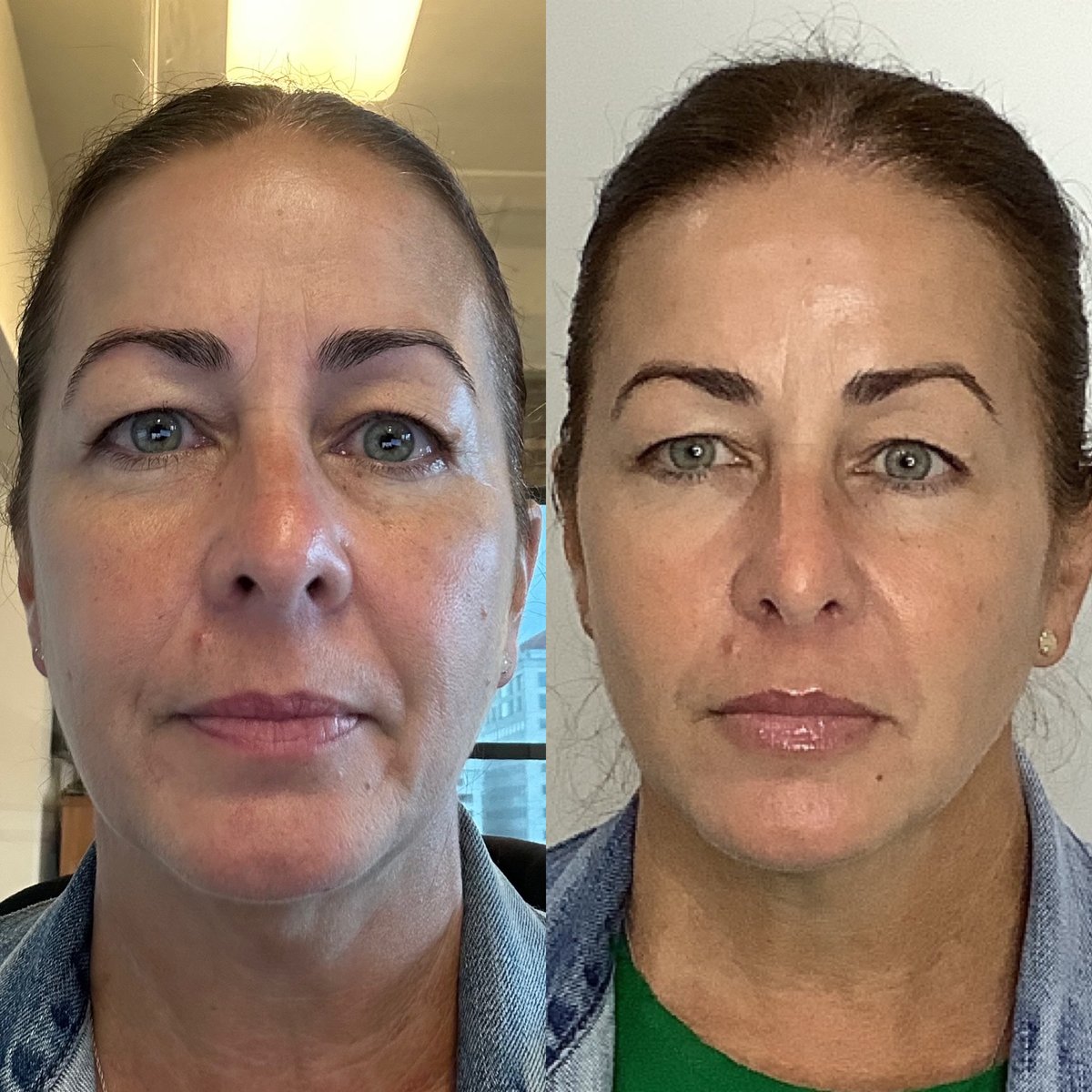 PUREHealthMiami's tweet photo. Natural enhancements that make you look refreshed. Schedule your neurotoxin and fillers today!
.⁣
.⁣
.⁣
.⁣
#dysport #botox #nurseinjector #medspa #filler #aesthetics #skincare #lipfiller #beauty #antiaging #lips #neurotoxin #prp #frownlines #xeomin #fillers #i... https://t.co/WrolVDOUfd