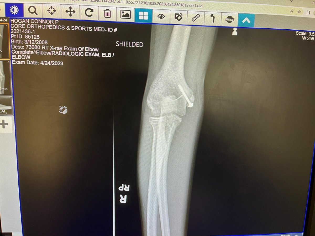 Got injured in my first baseball game for Lake Park. Had surgery 3 weeks ago and just got cleared for PT and working back to where I was before. @LPBaseball2023
