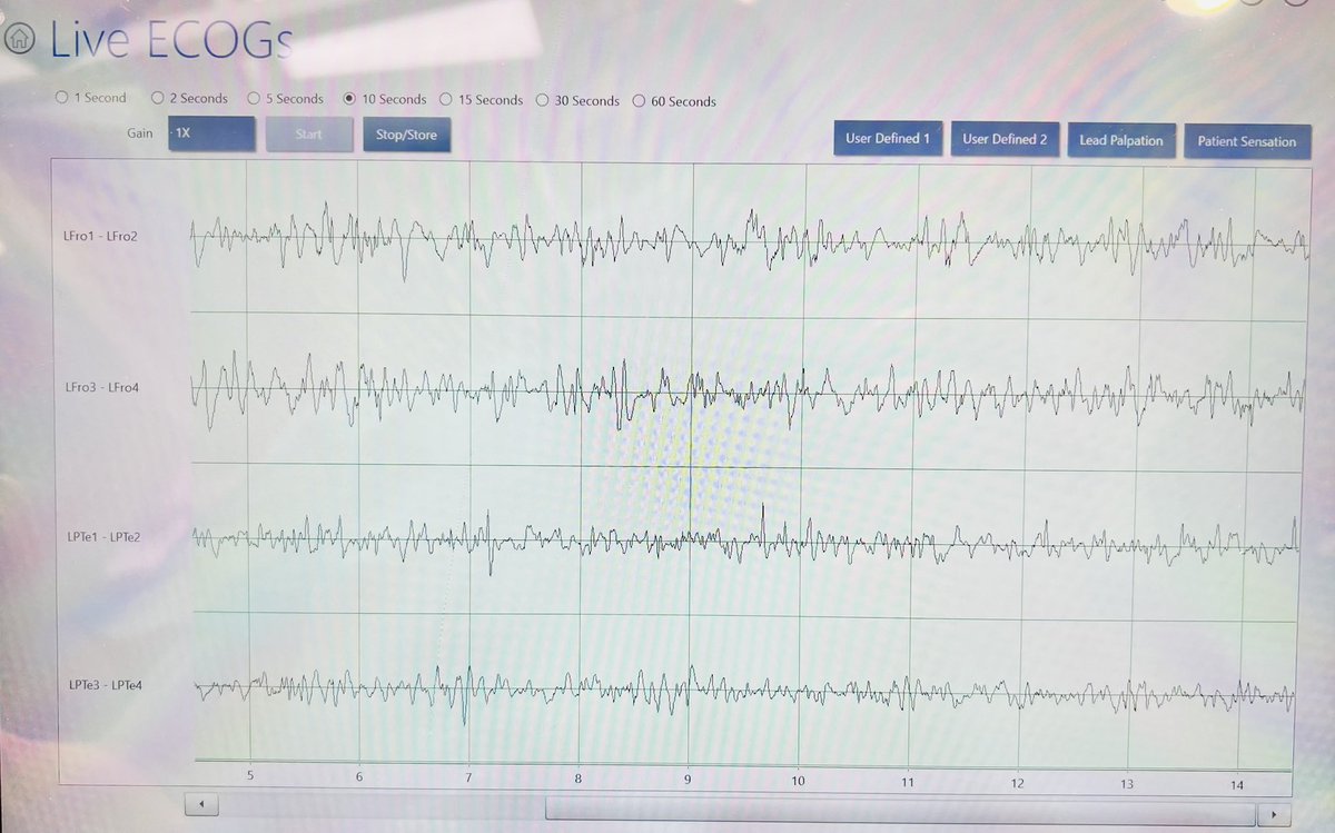 A case of subdural grids —> RNS. Started with monitoring plus language mapping <a href="/seattlechildren/">Seattle Children's</a> <a href="/UWNeurosurgery/">UW Neurological Surgery</a> but onset appears to straddle critical language areas. RNS is a great option for focal onset in eloquent brain regions. #Neurosurgery #NeuroTwitter