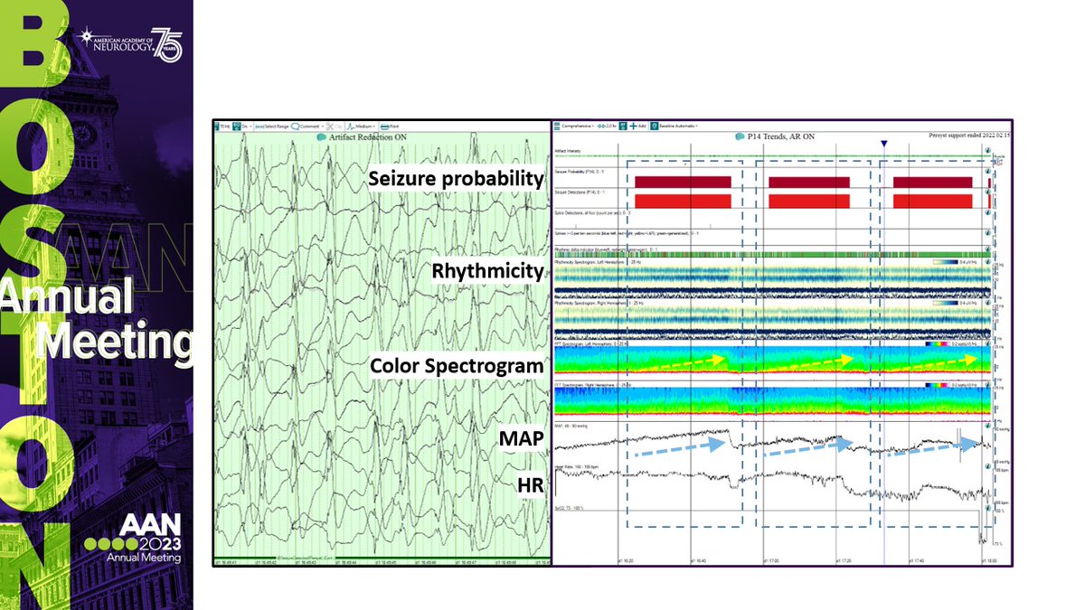 Giulia Benedetti (@giuliabene16) on Twitter photo Eager for a brain tease w/2 fascinating ped NCC cases at AAN? Check out C121/Room 153C/7:00AM 4/25! IIC & malignant neuroinflammatory cases. Guess what this multimodal pattern means before the session & come see if you're right. <a href="/PedQuEST_EEG/">PedQuEST</a> <a href="/Dr_Press/">Craig Press</a> <a href="/MattKirschen/">Matt Kirschen</a> <a href="/AppavuBrian/">Brian Appavu, MD</a> Eager for a brain tease w/2 fascinating ped NCC cases at AAN? Check out C121/Room 153C/7:00AM 4/25! IIC & malignant neuroinflammatory cases. Guess what this multimodal pattern means before the session & come see if you're right. <a href="/PedQuEST_EEG/">PedQuEST</a> <a href="/Dr_Press/">Craig Press</a> <a href="/MattKirschen/">Matt Kirschen</a> <a href="/AppavuBrian/">Brian Appavu, MD</a>