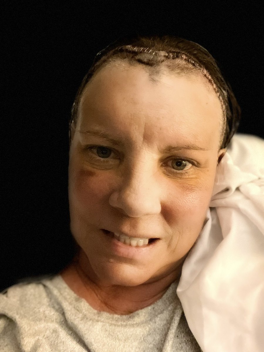 RockOnSuccess's tweet photo. Bs my meningioma was the size of a pool cue ball, pressing across both sides  of my frontal lobes and wreaking all kinds of havoc. Some can remain in place but mine caused debilitating symptoms…6 weeks post surgery and I am walking, talking, healing a bit more every day. If I fid mot speak up and pester my physicians for a brain scan, I’d likely be dead soon.

Doctors need to listen more holistically and pay ATTENTION. Patients need to speak up, and don’t give up till you find answers to fight for your life!