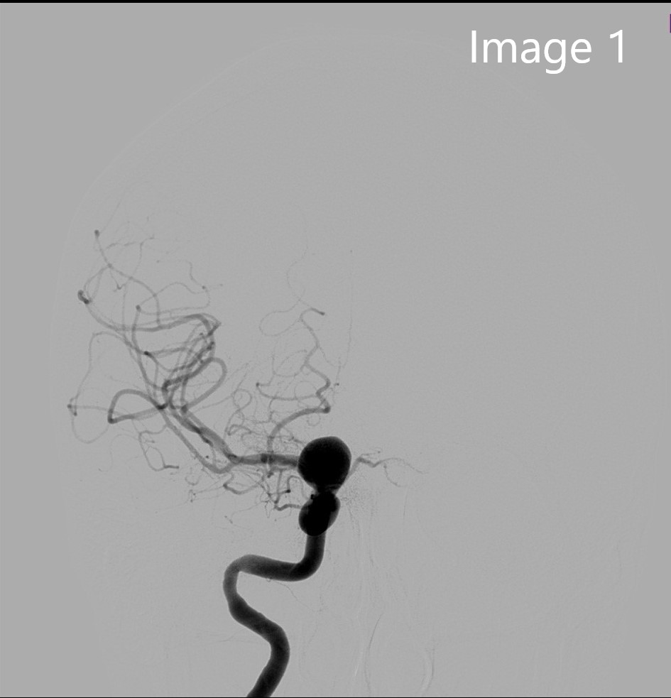 cirsesociety's tweet photo. Fifty-four-year-old patient with headache, with a finding of 16x11mm right internal carotid-ophthalmic artery aneurysm, treated by placement of flow diverter (images 1-2). (2/4) https://t.co/RtqZOBTQX3
