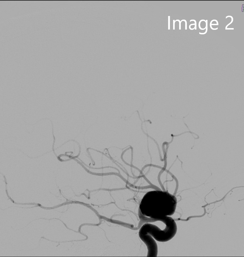 cirsesociety's tweet photo. Fifty-four-year-old patient with headache, with a finding of 16x11mm right internal carotid-ophthalmic artery aneurysm, treated by placement of flow diverter (images 1-2). (2/4) https://t.co/RtqZOBTQX3