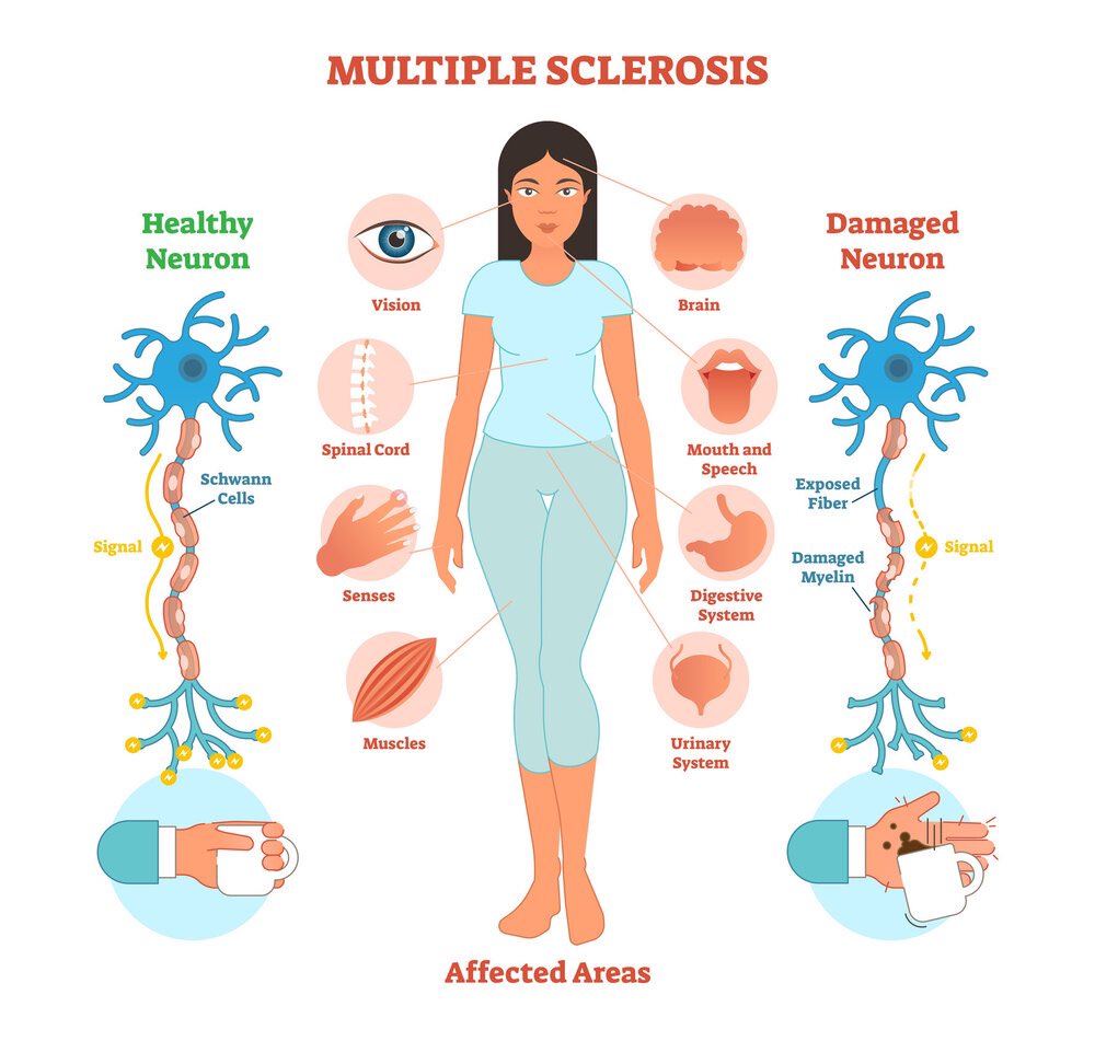 BlossomHomeCare's tweet photo. ❗️MS Awareness week❗️
MS can be tough, and for many people talking about it can be challenging.
🟥Be aware of the signs and symptoms don’t delay diagnosis there is treatments that can help
That’s why this MS Awareness Week we’re saying #LetsTalkMS. #sticktogether #support https://t.co/33I1dN30vx