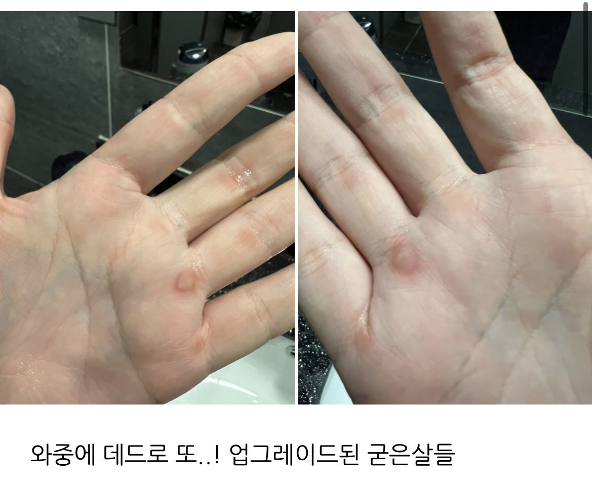 지미니 손에 굳은살 이또요..
데드리프트하면 생기는 전형적인 굳은살이래요… 우래기 열시미 운동핸나바요
푹 쉬구 운동하며 건강챙기구 있었나바요☺️