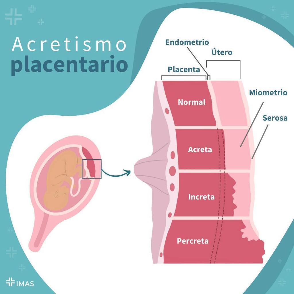 CursosImas's tweet photo. El acretismo placentario hace referencia a una inserción anómala de la placenta en la pared del útero. Su gravedad depende de la capa del útero afectada 

📌Acreta: las vellosidades pasan el endometrio, alcanzando al miometrio

📌Increta: las vellosida… https://t.co/ETLpxzMnVd https://t.co/zUGPufAGUK