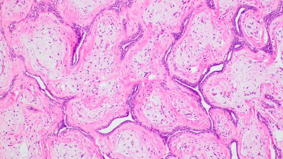 Without having seen the requisition form, when I placed the slide under the microscope, my first impression was fibroadenoma and I was completely incorrect! Its a skin biopsy! 🙃 #PathTwitter #dermpath #pathology