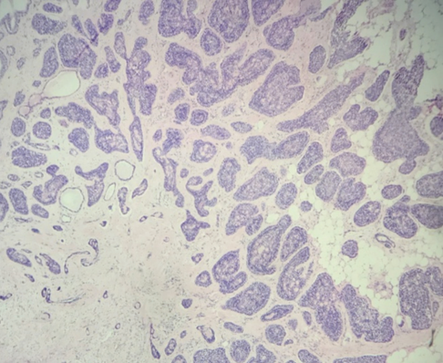 Cancer_Whioce's tweet photo. Welcome to read this article from Cancer Plus. 🤗Study on the #Clinicopathological Characteristics of #Adenoid Cystic #Carcinoma of the #Breast

Please see more detail at: 👇👇https://t.co/PsG57sR0fS https://t.co/gne8YAskNi