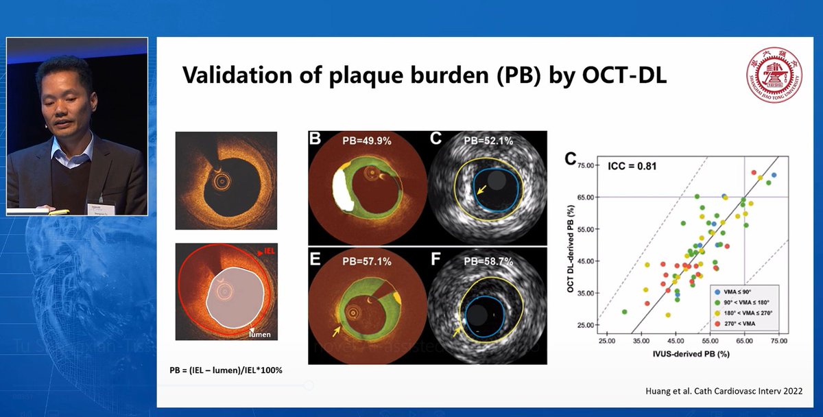 PulseMedTech's tweet photo. Pro. @ShengxianTu  from @sjtu1896 shared topic 'Tissue classification and novel AI assisted methods to assess plaque vulnerability' by using #OctPlus and #AngioPlusCore software (@PulseMedTech, shanghai). Live from #iPCI2023, Rotterdam,Netherlands. https://t.co/Zg6UKTwIVI https://t.co/bSP64x99xj