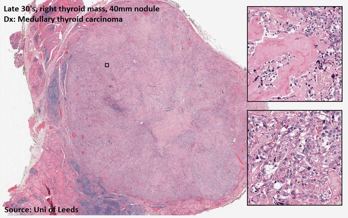 DrTravisBrown's tweet photo. Histology flash card
Medullary thyroid carcinoma (MTC)
1-2% thyroid cancers
70% sporadic (40-60yrs)
30% familial (av 35ys)
Neuroendocrine tumour (C cells)
⬆️serum calcitonin & CEA
Familial have germline RET mut
Discuss MEN syndrome #ThisPathLife #podcast Ep 40
#PathTwitter https://t.co/d82D0UVmSa