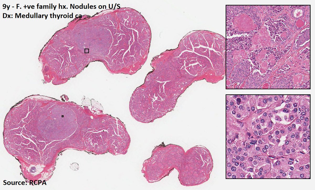 DrTravisBrown's tweet photo. Histology flash card
Medullary thyroid carcinoma (MTC)
1-2% thyroid cancers
70% sporadic (40-60yrs)
30% familial (av 35ys)
Neuroendocrine tumour (C cells)
⬆️serum calcitonin & CEA
Familial have germline RET mut
Discuss MEN syndrome #ThisPathLife #podcast Ep 40
#PathTwitter https://t.co/d82D0UVmSa