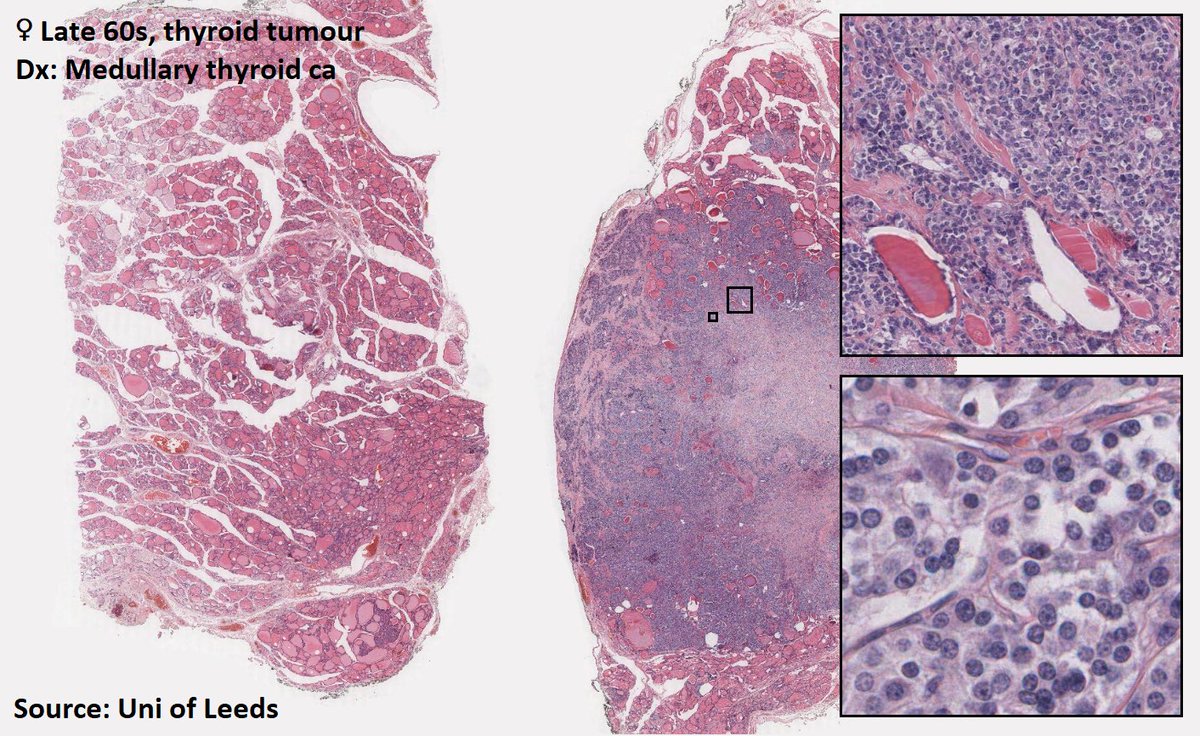 DrTravisBrown's tweet photo. Histology flash card
Medullary thyroid carcinoma (MTC)
1-2% thyroid cancers
70% sporadic (40-60yrs)
30% familial (av 35ys)
Neuroendocrine tumour (C cells)
⬆️serum calcitonin & CEA
Familial have germline RET mut
Discuss MEN syndrome #ThisPathLife #podcast Ep 40
#PathTwitter https://t.co/d82D0UVmSa