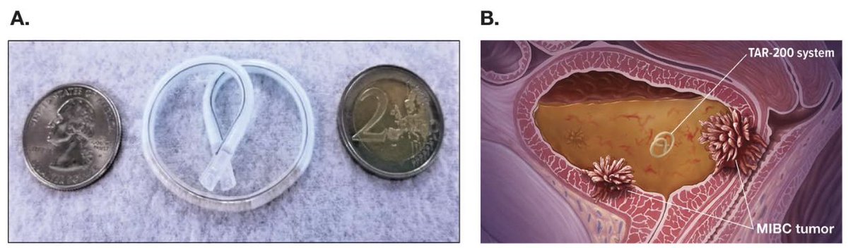DrFelixGuerrero's tweet image. 📝 Happy to share our paper at @JUrology reporting results of TAR-200-103 phase I trial w/ TAR-200 in #MIBC unfit for cystectomy
👥 Collaboration w/ @RodriguezFaba @joanfundi among others
🤓 Take a look: shorturl.at/sHUW5
😃 Exciting times ahead for #bladdercancer patients