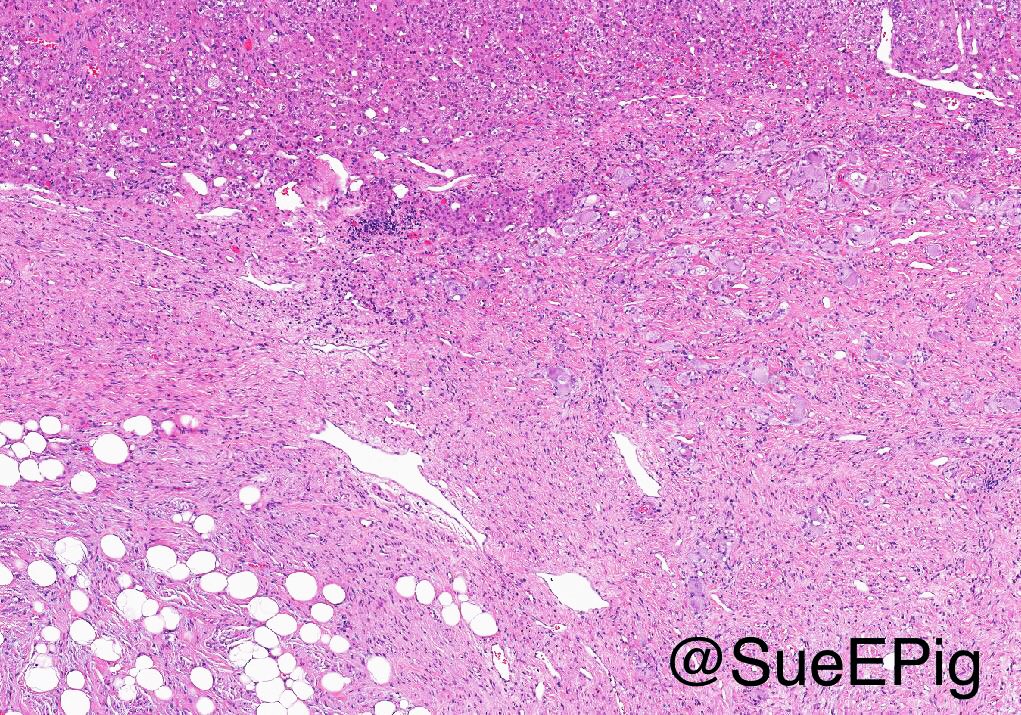 SueEPig's tweet photo. Ganglioneuroma showing spindled Schwannian stroma and mature ganglion cells with intermixed adipose tissue, residual adrenal cortical cells present #IUpath #pathoutpic https://t.co/sa4iPQaskD