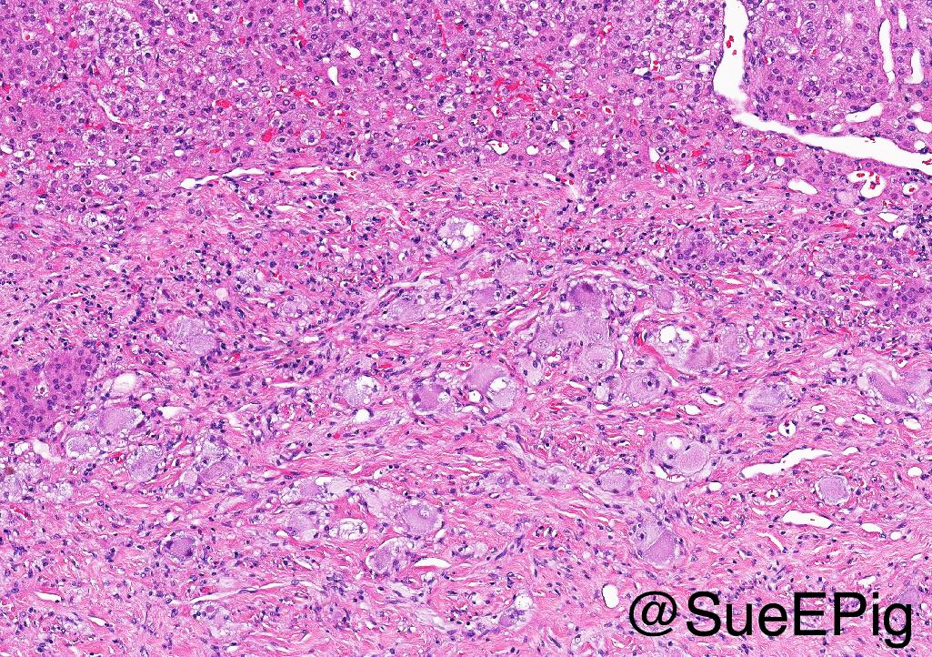 SueEPig's tweet photo. Ganglioneuroma showing spindled Schwannian stroma and mature ganglion cells with intermixed adipose tissue, residual adrenal cortical cells present #IUpath #pathoutpic https://t.co/sa4iPQaskD