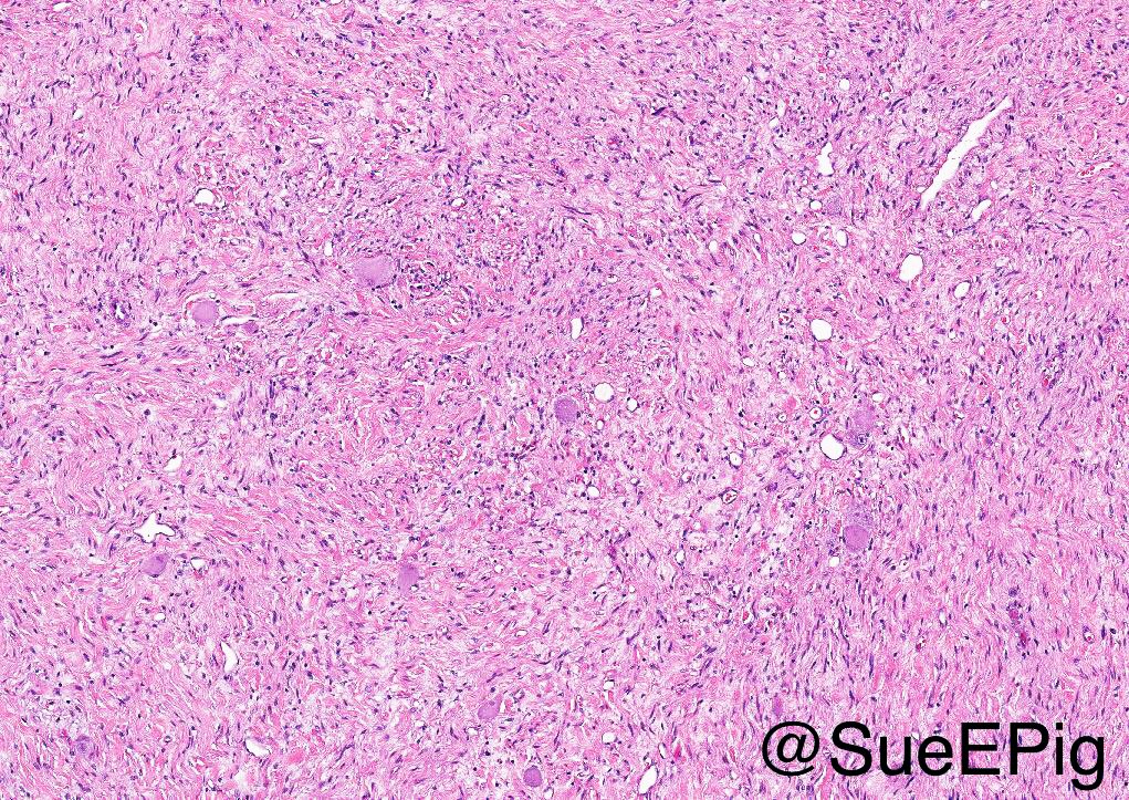 SueEPig's tweet photo. Ganglioneuroma showing spindled Schwannian stroma and mature ganglion cells with intermixed adipose tissue, residual adrenal cortical cells present #IUpath #pathoutpic https://t.co/sa4iPQaskD