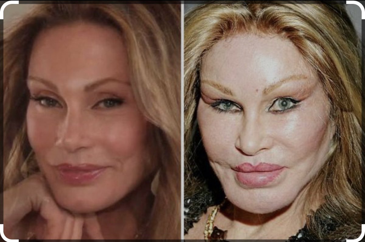 modeloscallan's tweet photo. When Enough is enough? I see friends taking the same path without seeing they are turning into monsters #plasticsurgery #obsesion #faces #BeautyAndTheBeast #beauty #addict https://t.co/s7s8M64URw