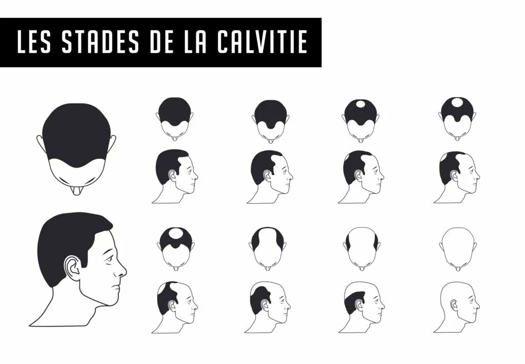 Huile de noyau d'avocat pour la perte de cheveux - KATSURA Hair N Stylist  Selection !