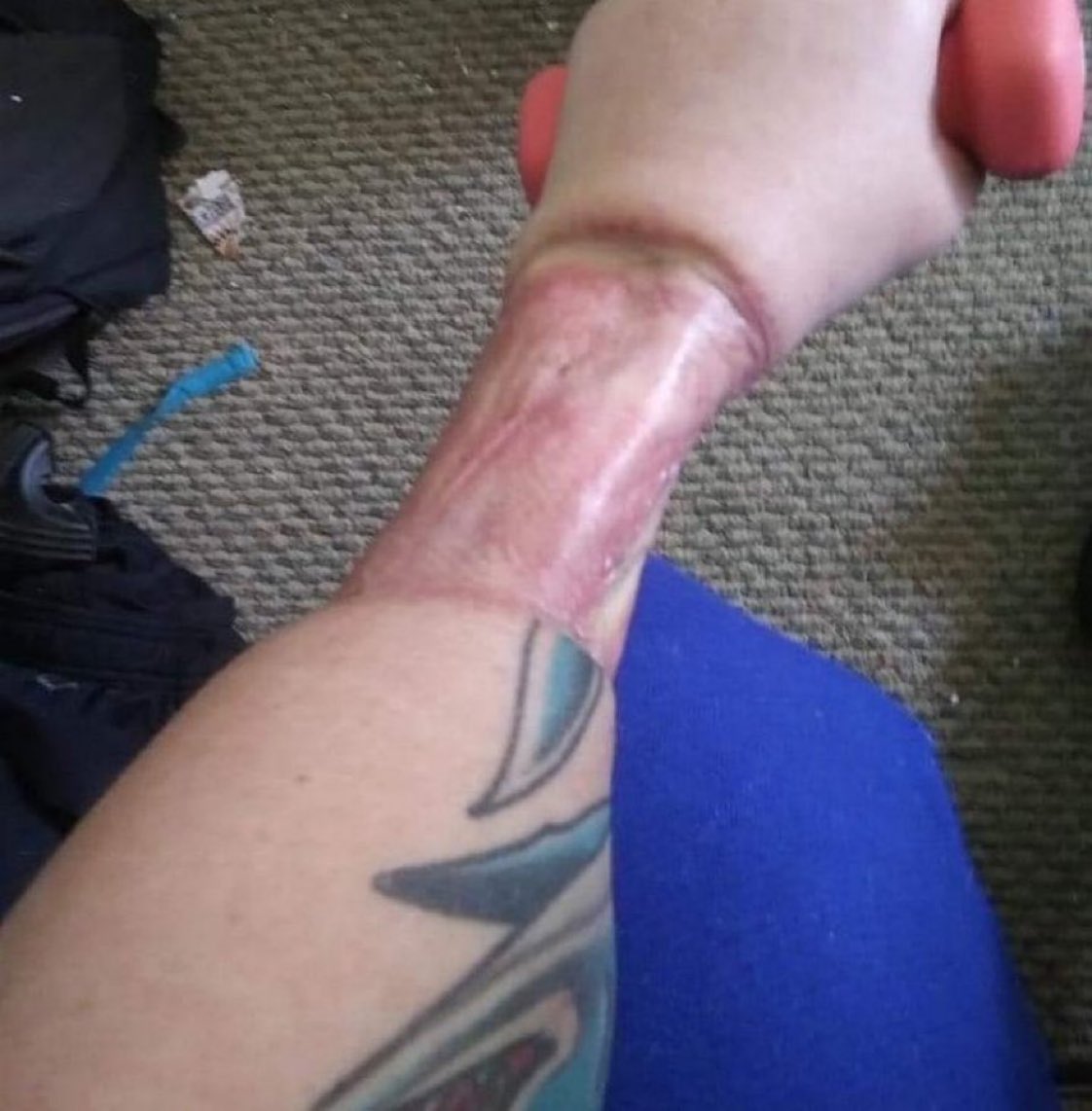 DrLoupis's tweet photo. This is a girl’s forearm. Her muscles have been farmed to create a fake phallus that doesn’t function. They will try to make her a fake urethra. She’ll probably be incontinent, she will certainly never function like a man. And her muscles won’t grow back.

Google ‘phalloplasty’. https://t.co/MGj3x5rIHN