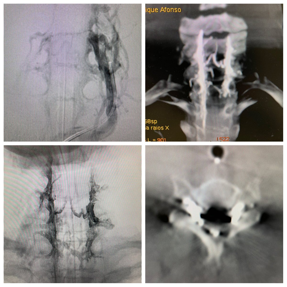 ikeafonso1's tweet photo. Multiple CSF venous fistula treated w Scepter and Squid 18 in 🇧🇷. Thanks to all colleagues and researchers who have been developing this field and influenced me! @WBrinjikji @WouterSchievink @PeterGKranz @TDobrocky https://t.co/azys9skYpt
