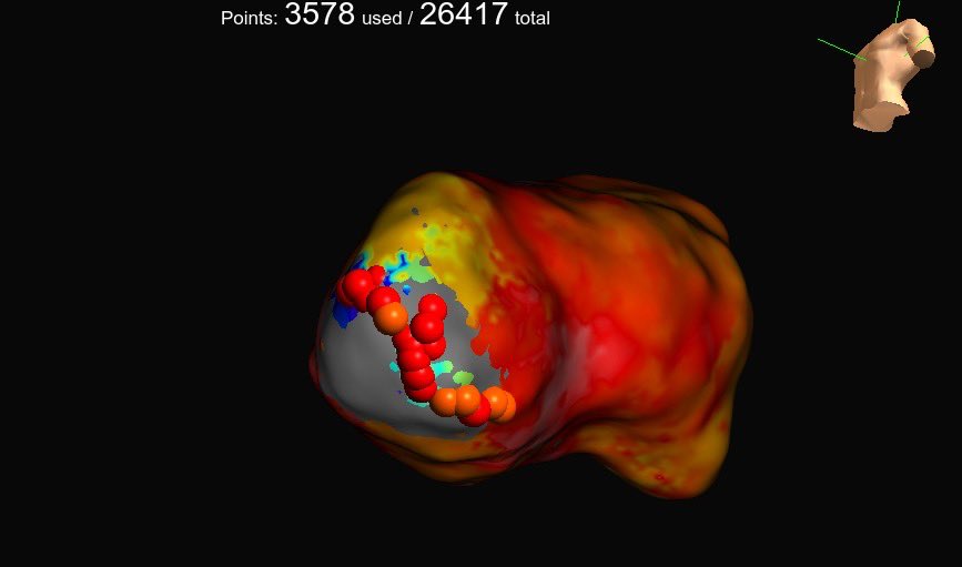 Jacqueline Held (@jacqueheld_ep) on Twitter photo Beautiful signal seen with the #HDGrid of an ischemic VT. Mapped and ablated by <a href="/MonicaYLo/">Monica Lo MD FHRS FACC</a>
<a href="/AbbottCardio/">Abbott Cardiovascular</a> #EnsiteX #OT #EmphasisMaps #AbbottProud Beautiful signal seen with the #HDGrid of an ischemic VT. Mapped and ablated by <a href="/MonicaYLo/">Monica Lo MD FHRS FACC</a>
<a href="/AbbottCardio/">Abbott Cardiovascular</a> #EnsiteX #OT #EmphasisMaps #AbbottProud