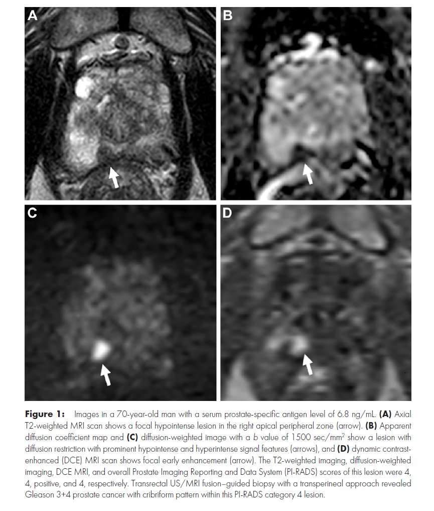 Baris Turkbey MD tweet media