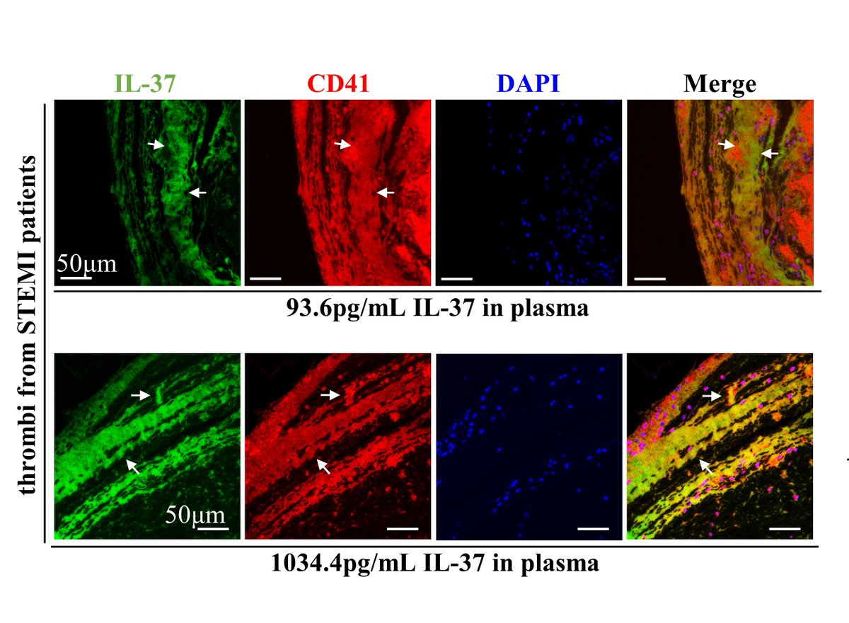 CircRes's tweet photo. First time publishing in @Circ Res, Chen et al found that #IL37 attenuates #platelet activation and #thrombosis through# IL-1R8 pathway, may have therapeutic advantages as potential #antiplatelet drugs. https://t.co/0yb1vWJFgL
@FudanUniv https://t.co/Wx7Ndw0Xyc