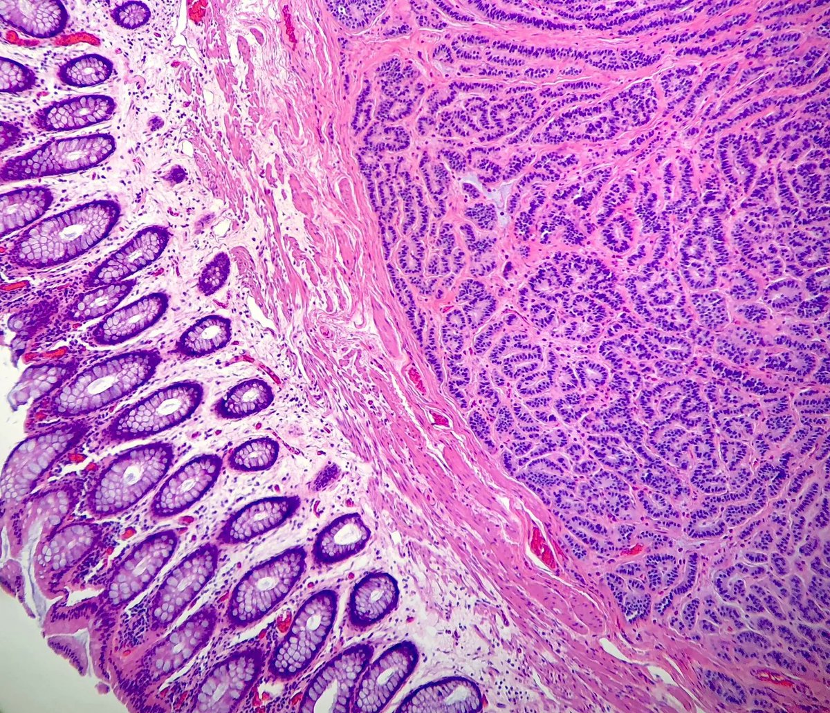 Gloria_SuraMD's tweet photo. Rectal biopsy revealing an unexpected finding. What is your diagnosis? Answer: https://t.co/umP0hLoFeG #PathArt #PathTwitter #MedTwitter https://t.co/MITDsiZFvX