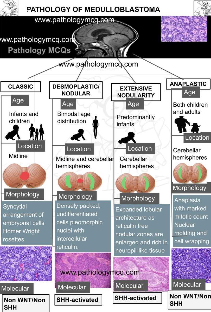 CHARACTERISTICS OF HISTOLOGIC SUBTYPES OF MEDULLOBLASTOMA #pathboards #pathboard #pathology #pathologist #pathologists #pathresidents #pathologymcq #pathtwitter #neuropath #molecular #molecularpathology #neuropathology #medulloblastoma