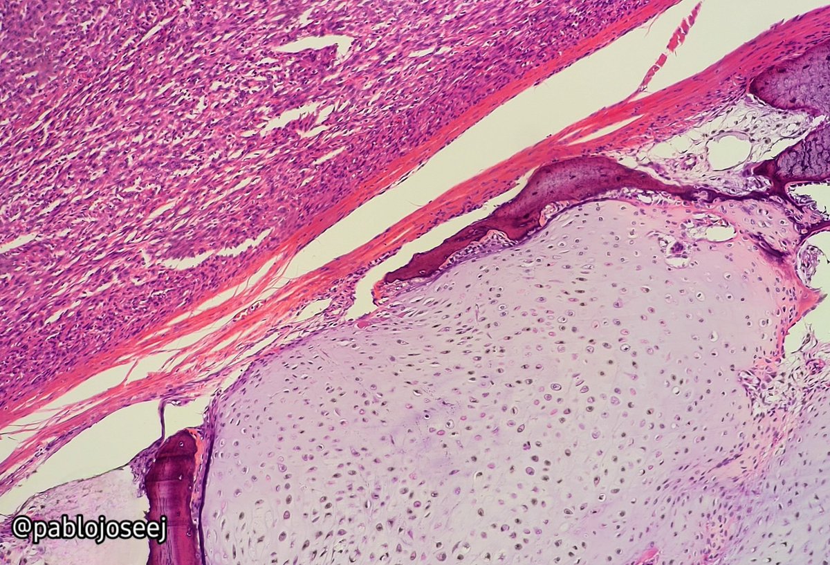 🦴Dedifferentiated chondrosarcoma.🦴

Left: high grade noncartilaginous sarcoma / Right: conventional chondrosarcoma.

#Pathology #AnatomiaPatologica #Pathologyst 
#BSTpath 
#PathTwitter