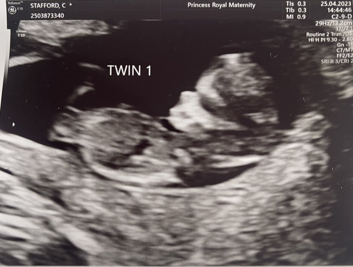 wee_bubsxox's tweet photo. Never in my wildest dreams did I ever think that my little heart would be bursting with so much love ❤️❤️

My little miracles due in November 2023 ❤️❤️

I feel like the luckiest woman in the world to finally see two healthy, strong babies bouncing around ❤️❤️ https://t.co/cpGqdnzsPt