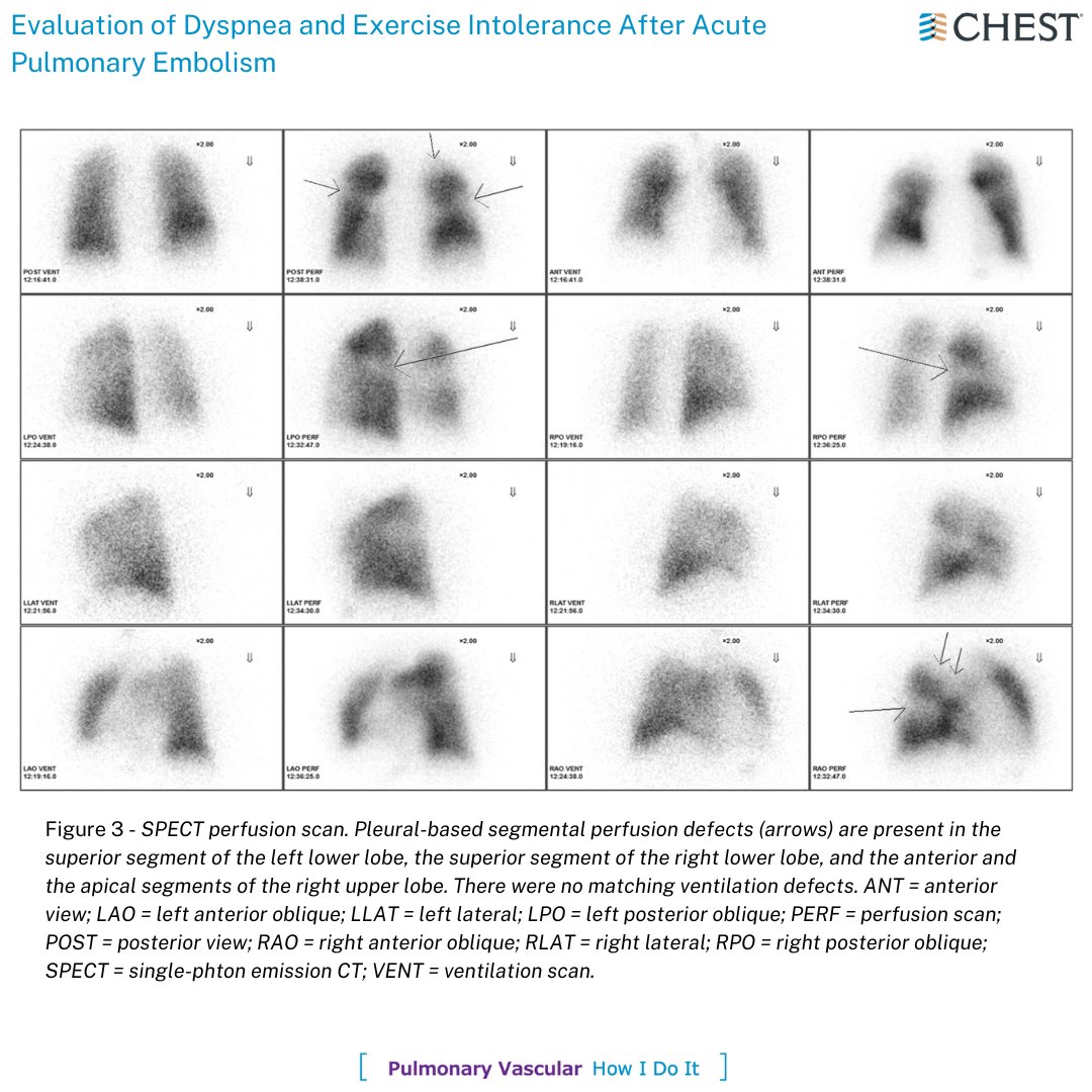 accpchest's tweet photo. A #HowIDoIt from the April issue illustrates a stepwise approach to post-pulmonary embolism evaluation that uses a hierarchic series of clinically validated diagnostic tests. Read the full article in the latest @journal_CHEST issue: https://t.co/NQb4BVjtFN
#MedEd #MedTwitter https://t.co/wOTEW6prOW