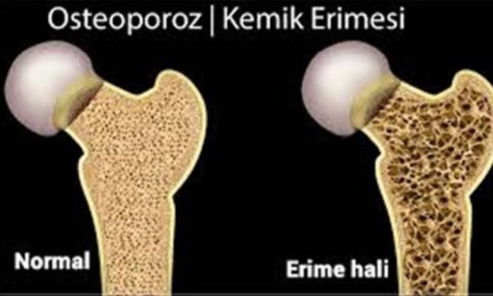 🔴KEMİK ERİMESİ

📌SORU:
➖️"Kalsiyum ve D vitamini kullanıyorum ama kemik erimesi düzelmiyor, Neden?"

➖️Çünkü alınan kalsiyum damarlarda kaldı.  Ve hatta böbreklerde,bazı dokularda ve damarlarda kalsifikasyon (kireclenme) oluştu...

🔴En baştan başlayalım kemik oluşturalım