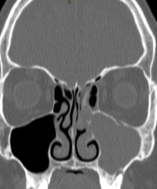 DrScottFortune's tweet photo. How it started. How it's going. #ODS #odontogenicsinusitis #ChronicMaxillarySinusitis #CTscanSinuses #EndoscopicSinusSurgery @JohnCraigNose @ent_ams https://t.co/tNPv2utq3p