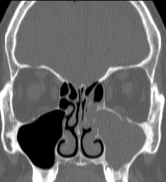 DrScottFortune's tweet photo. How it started. How it's going. #ODS #odontogenicsinusitis #ChronicMaxillarySinusitis #CTscanSinuses #EndoscopicSinusSurgery @JohnCraigNose @ent_ams https://t.co/tNPv2utq3p