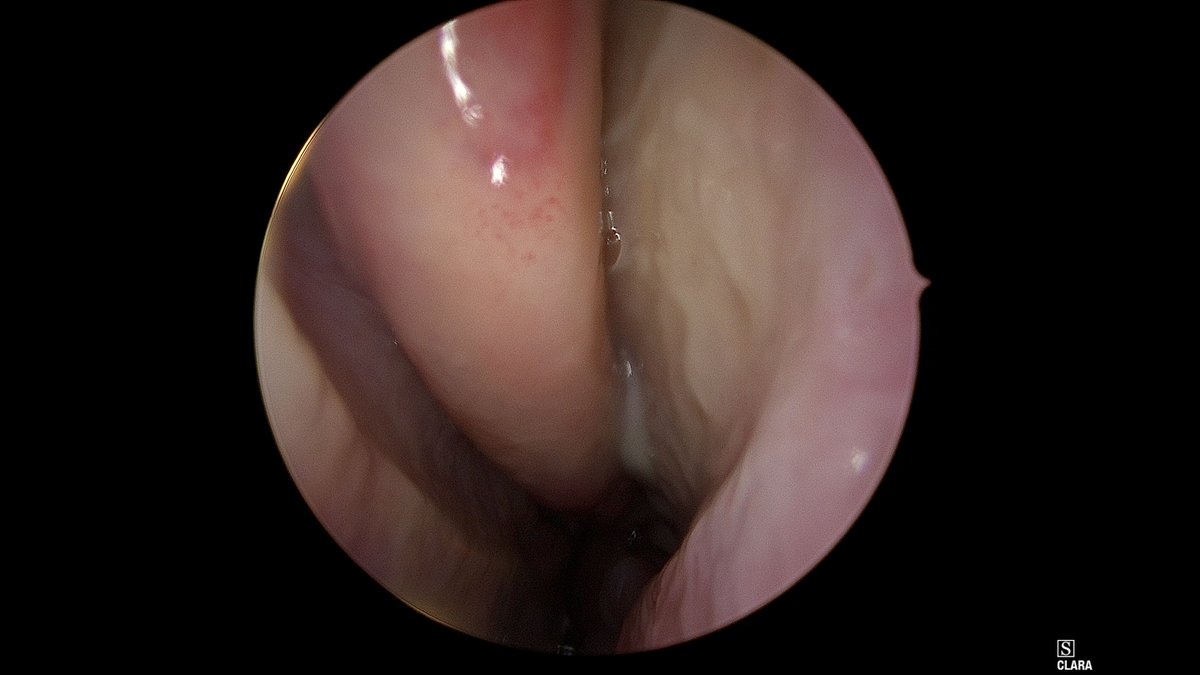 DrScottFortune's tweet photo. How it started. How it's going. #ODS #odontogenicsinusitis #ChronicMaxillarySinusitis #CTscanSinuses #EndoscopicSinusSurgery @JohnCraigNose @ent_ams https://t.co/tNPv2utq3p