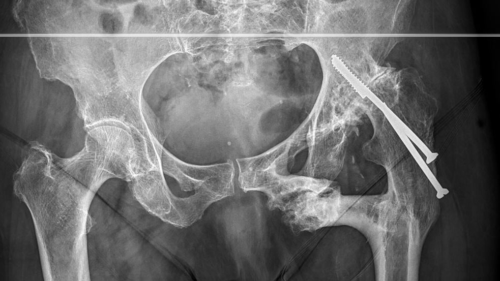 JM_Zulueta_O's tweet photo. Caso "vintage" del mes: paciente que acude por TCE en el contexto de "episodio de bloqueo" del miembro inferior izquierdo.  TC craneal sin lesiones agudas. Pasados 3 meses  se realiza RX de pelvis, sin indicar el motivo de consulta. https://t.co/umoVdAXdE5