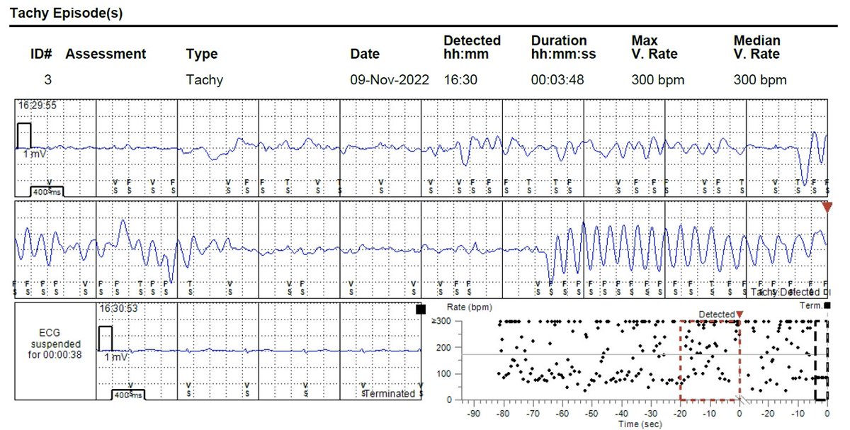 chris_monkhouse's tweet photo. For those who couldn't join #tracestuesday. The winner of trace of the week was this ILR recording during an MRI scan! With ILR devices not needing pre-programming maybe you'll see this on an ILR near you. @BHRSociety @James_Elliott01 @PaulndohertyCRM #epeeps @IbhreInfo #EGeM https://t.co/iCDdlcpldi